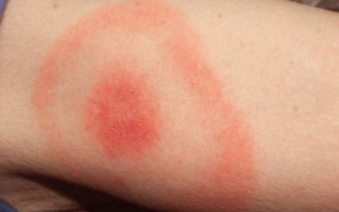 Doença de Lyme: Causas, Sintomas e Tratamento | AJAX Soluções