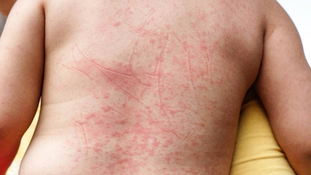 Dengue: Sintomas e Como Prevenir| AJAX Soluções
