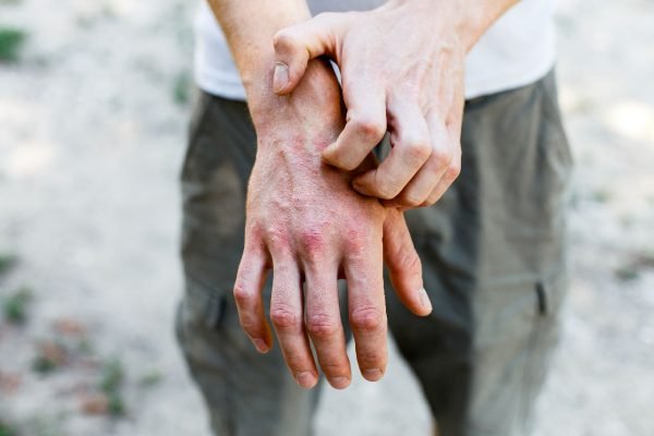 Remédio Caseiro para Sarna Humana